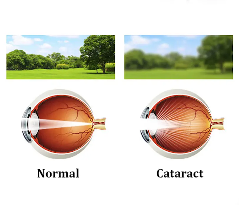 Cataract