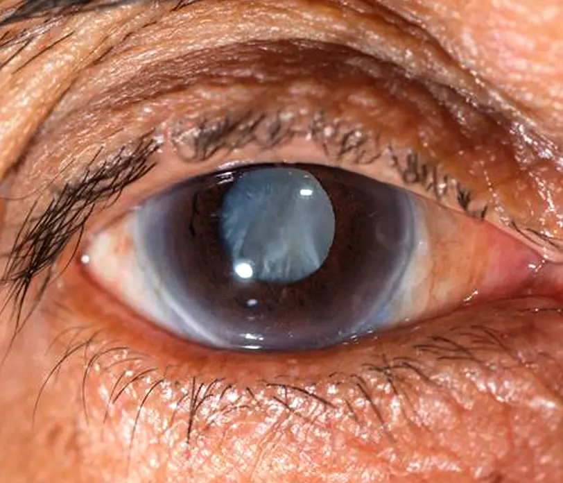 Glaucoma