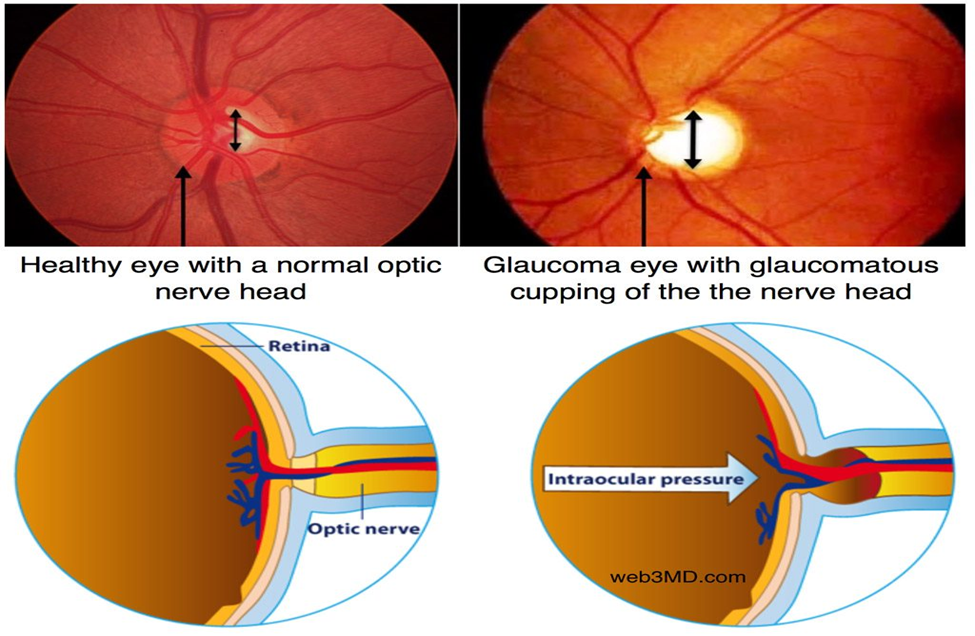 Glaucoma Comparison Image